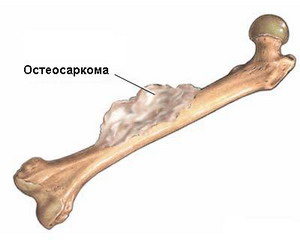 Остеогенные саркомы (остеосаркома)